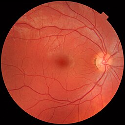 Fundus Photograph